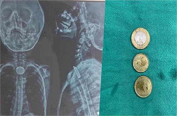 child swallowed three coins