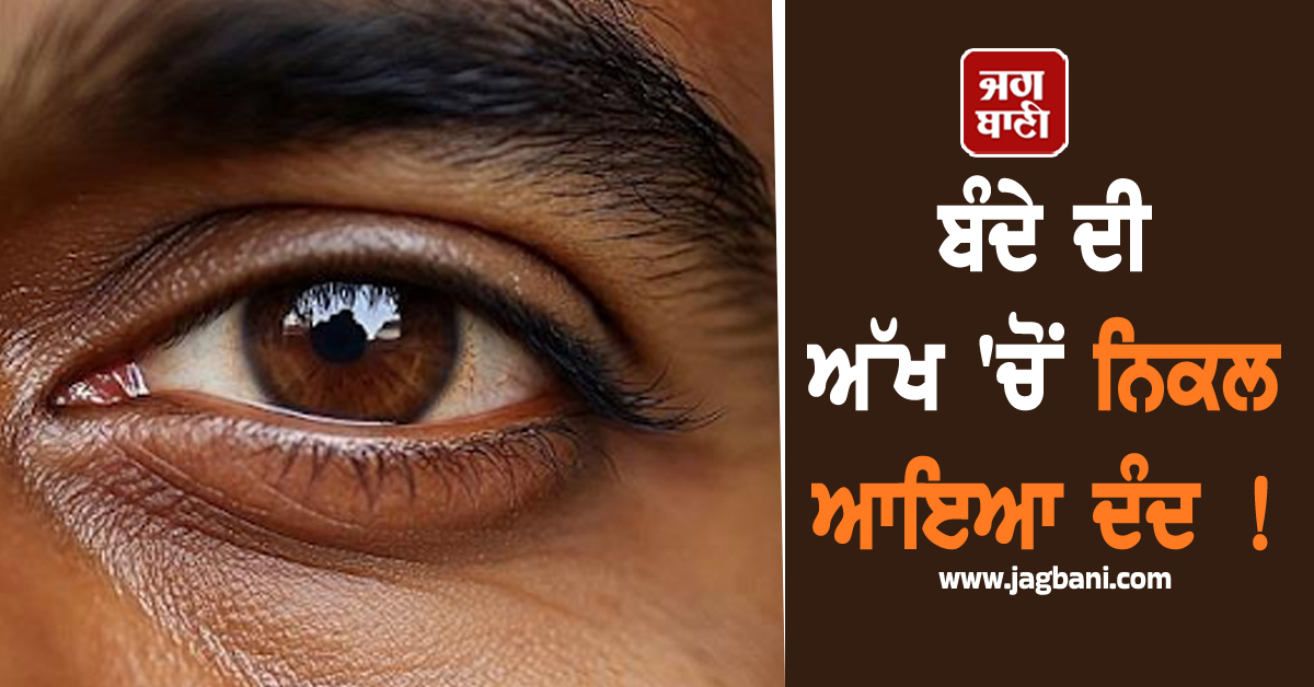 ਬੰਦੇ ਦੀ ਅੱਖ ''ਚੋਂ ਨਿਕਲ ਆਇਆ ਦੰਦ ! ਦੇਖ ਡਾਕਟਰ ਵੀ ਰਹਿ ਗਏ ਹੱਕੇ-ਬੱਕੇ