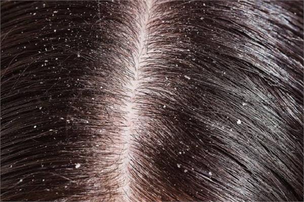 if you are troubled by dandruff  try these methods 