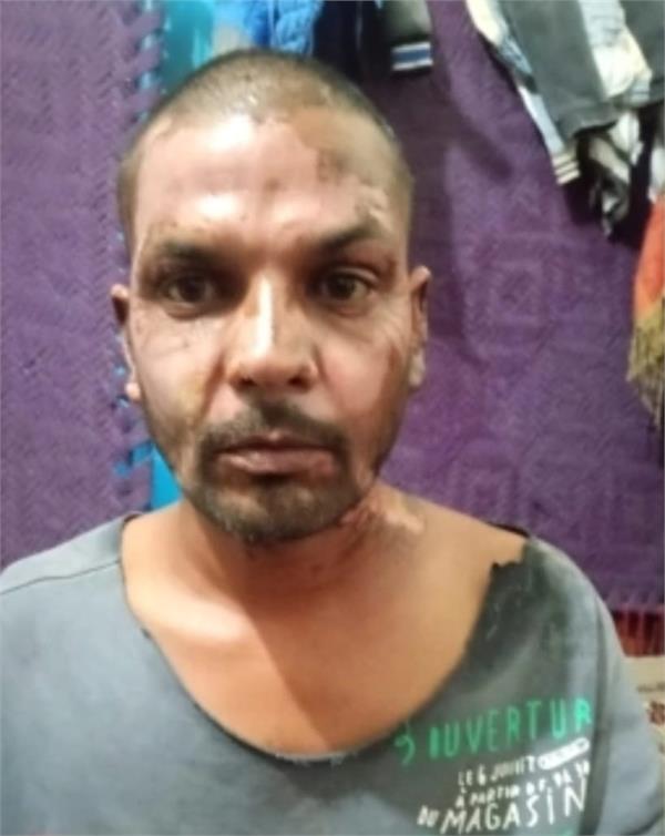 christian man set on fire in pakistan face and neck burned