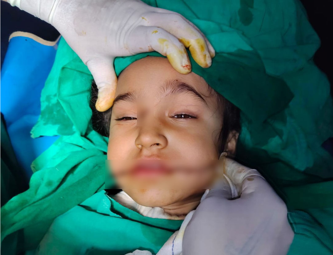 ਮੂਕ ਦਰਸ਼ਕ ਬਣੀ ਪੁਲਸ: ਖੂਨੀ ਚਾਈਨਾ ਡੋਰ ਦੀ ਲਪੇਟ ''ਚ ਆਈ ਮਾਸੂਮ ਬੱਚੀ, ਮੂੰਹ ’ਤੇ ਲੱਗੇ 40 ਟਾਂਕੇ