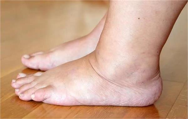 4 symptoms in your feet could signal