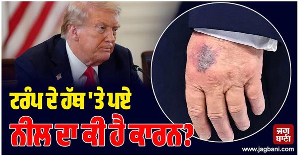 what is the reason for the mole on trump s hand 