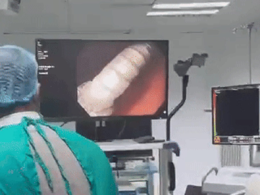 ਖੇਡ-ਖੇਡ ''ਚ ਜਵਾਕ ਨੇ ਨਿਗਲੀ 3 ਸੈਂਟੀਮੀਟਰ ਲੰਬੀ ਕਿੱਲ, ਹਸਪਤਾਲਾਂ ਨੇ ਖੜ੍ਹੇ ਕੀਤੇ ਹੱਥ, ਫਿਰ ਇੰਝ ਬਚੀ ਜਾਨ