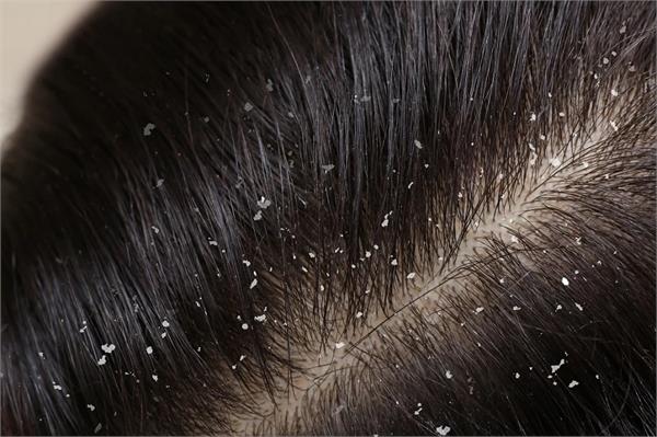 home remedies for dandruff problem