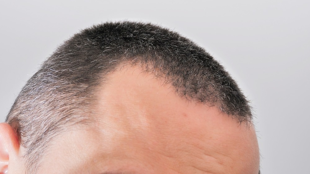 ਮਰਦਾਂ ''ਚ ਵੱਧ ਰਿਹਾ ਗੰਜੇਪਨ ਦਾ ਖ਼ਤਰਾ! ਜਾਣੋ ਤਣਾਅ ਅਤੇ ਖ਼ੁਰਾਕ ਦੀ ਕਮੀ ਕਿਵੇਂ ਬਣ ਰਹੀ ਹੈ ਵਾਲਾਂ ਦੀ ਦੁਸ਼ਮਣ