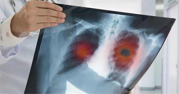 lung cancer is affecting young people