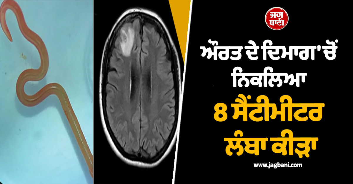 ਬਚਪਨ ਦੀ ''ਗ਼ਲਤੀ'' ਪਈ ਮਹਿੰਗੀ! ਔਰਤ ਦੇ ਦਿਮਾਗ ''ਚੋਂ ਨਿਕਲਿਆ 8 ਸੈਂਟੀਮੀਟਰ ਲੰਬਾ ਕੀੜਾ