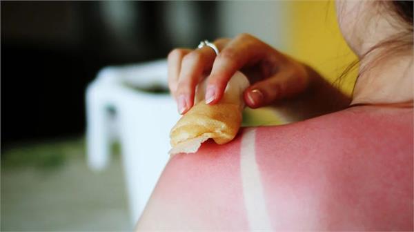 follow these home remedies to get instant relief from sunburn 