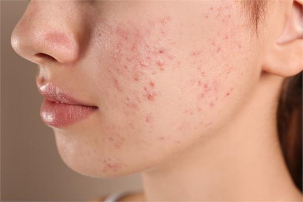 stubborn scars remain on the face after pimples