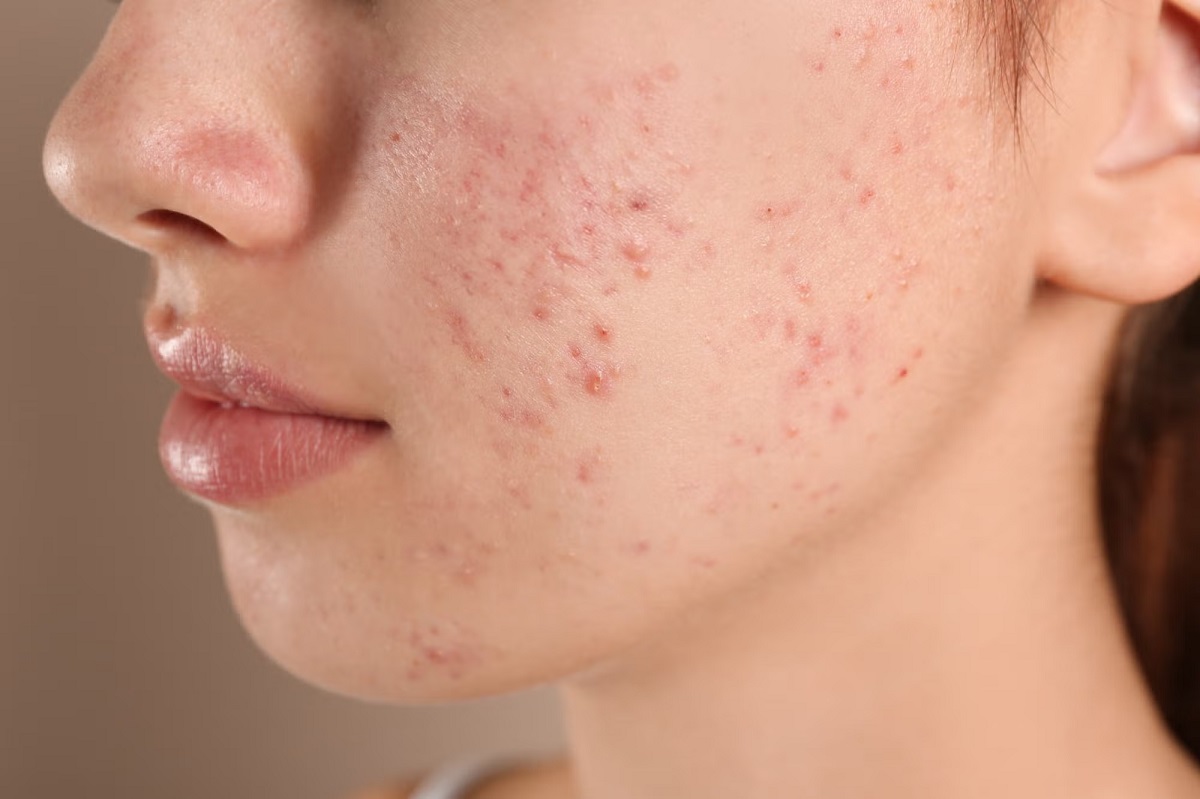 Pimples ਤੋਂ ਬਾਅਦ ਚਿਹਰੇ ''ਤੇ ਰਹਿ ਗਏ ਹਨ ਜ਼ਿੱਦੀ ਦਾਗ ਤਾਂ  ਇਨ੍ਹਾਂ ਘਰੇਲੂ ਨੁਸਖਿਆਂ ਨਾਲ ਪਾਓ ਕਰੋ ਠੀਕ