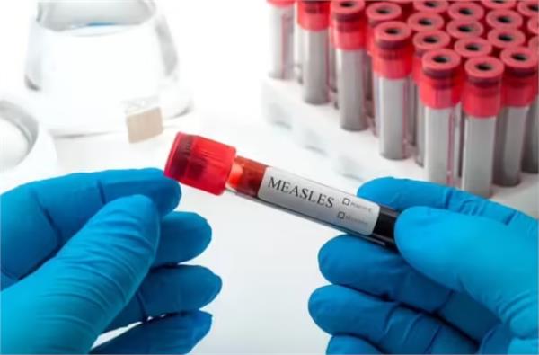 measles outbreak in bangldesh