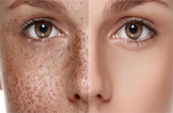 mistaking tanning and pigmentation as one can be a huge mistake 