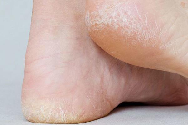 if you are also bothered by cracked heels  then   