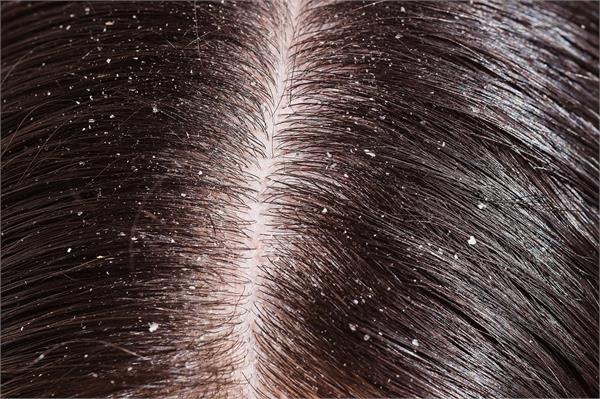 use these home remedies to get rid of dandruff 