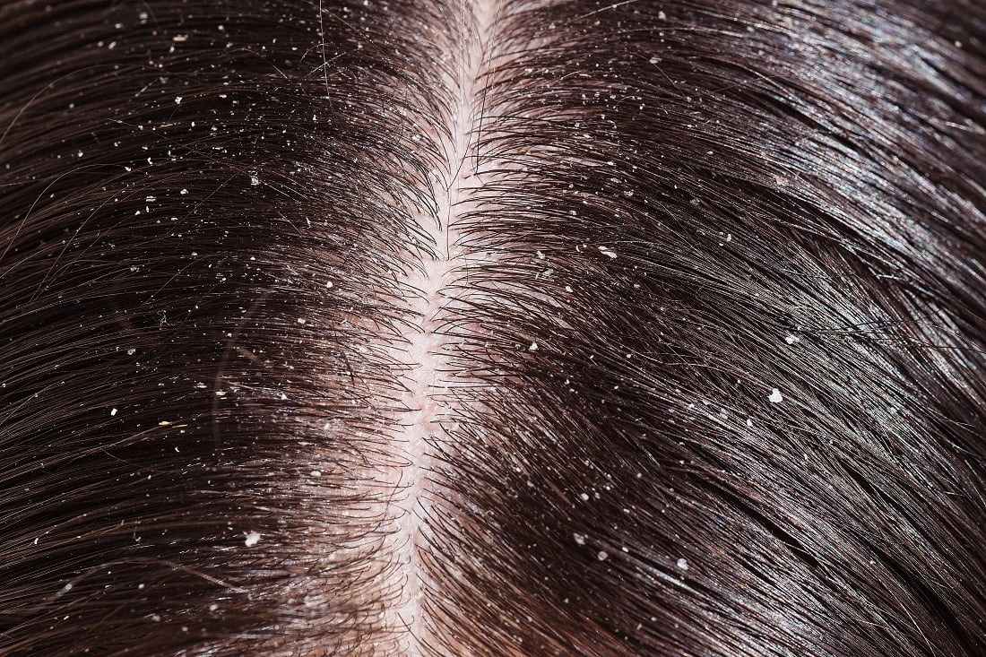 Dandruff ਤੋਂ ਛੁਟਕਾਰਾ ਪਾਉਣ ਲਈ ਵਰਤੋਂ ਇਹ ਘਰੇਲੂ ਨੁਸਖੇ