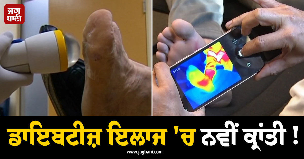 ਡਾਇਬਟੀਜ਼ ਇਲਾਜ 'ਚ ਨਵੀਂ ਕ੍ਰਾਂਤੀ ! ਹੁਣ AI ਕੈਮਰਾ ਬਚਾਏਗਾ ਸ਼ੂਗਰ ਦੇ ਮਰੀਜ਼ਾਂ ਦੀਆਂ ਲੱਤਾਂ-ਬਾਹਾਂ